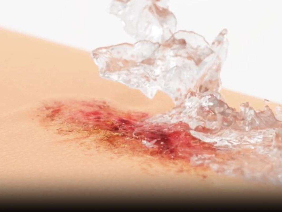 Granudacyn® Wound Irrigation Solution & Gel